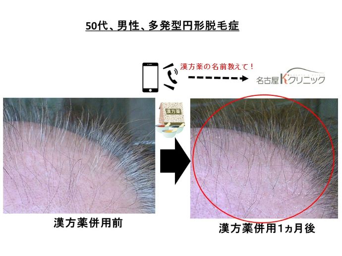 円形脱毛症　病院